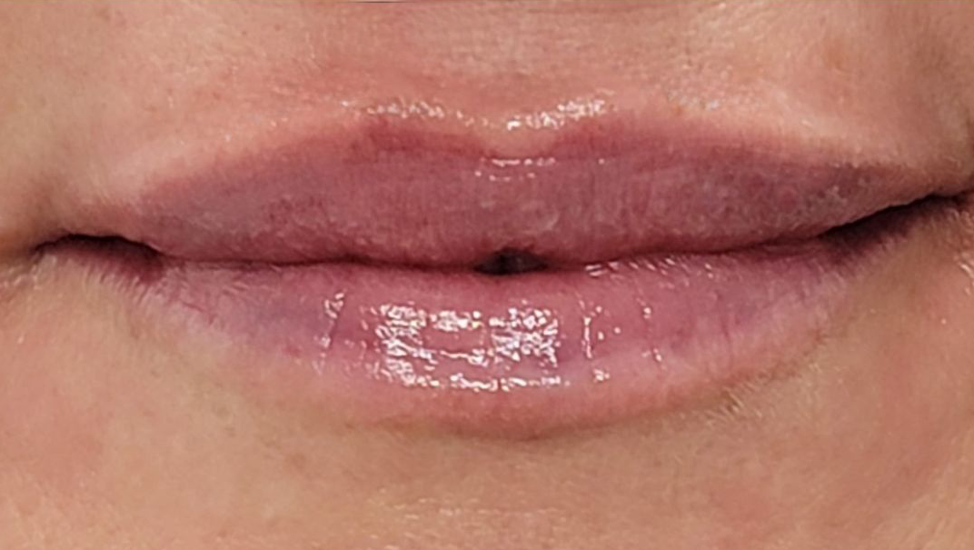Lip Filler AFTER