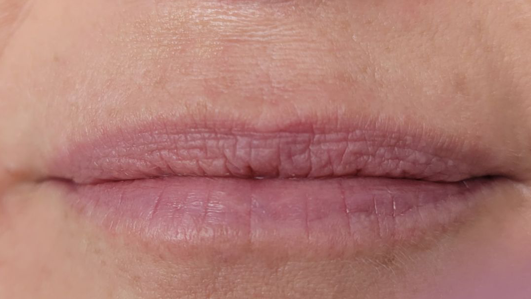 Lip Filler BEFORE