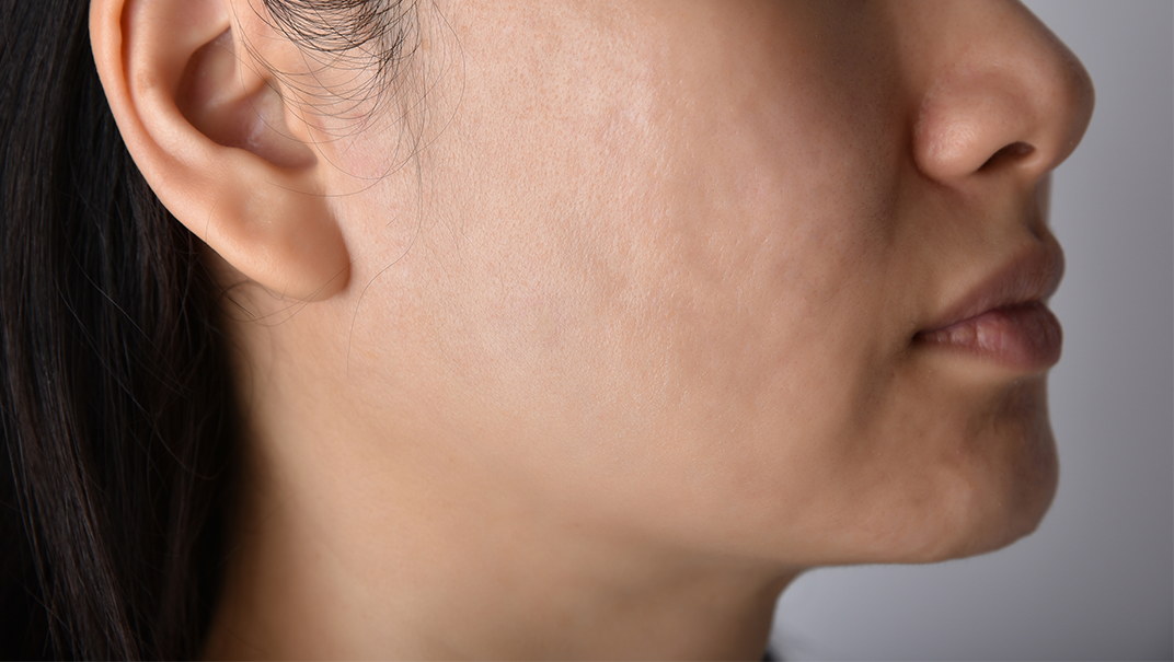 After ACNE Treatment