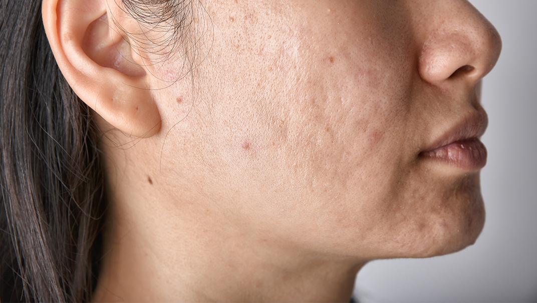 Before ACNE Treatment